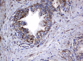 HSPD1 / HSP60 Antibody - IHC of paraffin-embedded Carcinoma of Human prostate tissue using anti-HSPD1 mouse monoclonal antibody.