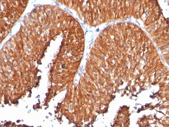 HSPD1 / HSP60 Antibody - Formalin-fixed, paraffin-embedded human bladder carcinoma stained with anti-HSP60 antibody (SPM253).  This image was taken for the unmodified form of this product. Other forms have not been tested.