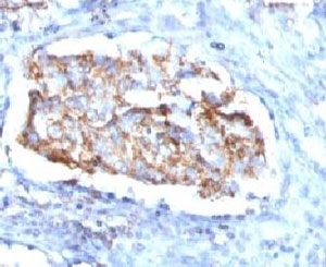 HSPD1 / HSP60 Antibody - IHC testing of human lung carcinoma and HSP60 antibody (clone SRPR60).  This image was taken for the unmodified form of this product. Other forms have not been tested.