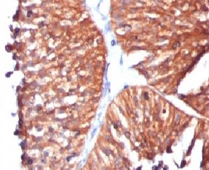 HSPD1 / HSP60 Antibody - IHC testing of human bladder carcinoma and HSP60 antibody (clone SRPR60).  This image was taken for the unmodified form of this product. Other forms have not been tested.