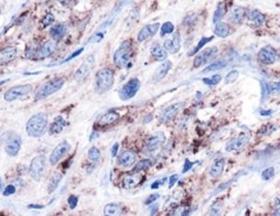 HSPD1 / HSP60 Antibody - Immunohistochemistry: Hsp60 Antibody - IHC of HSP60 in human kidney carcinoma using DAB with hematoxylin counterstain.  This image was taken for the unconjugated form of this product. Other forms have not been tested.