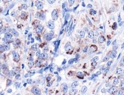 HSPD1 / HSP60 Antibody - Immunohistochemistry: Hsp60 Antibody - IHC of HSP60 in human kidney carcinoma using DAB with hematoxylin counterstain.  This image was taken for the unconjugated form of this product. Other forms have not been tested.