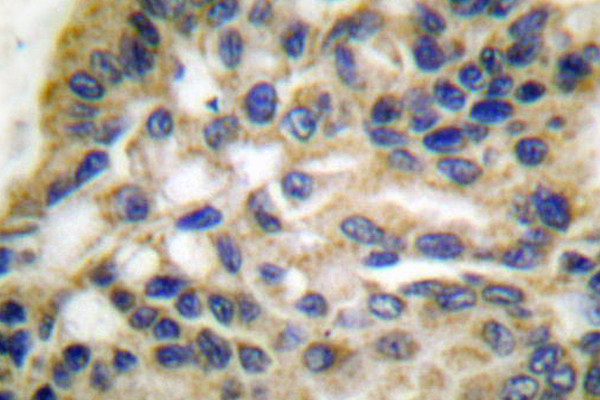 HSPD1 / HSP60 Antibody - IHC of HSP60/HSPD1 (T547) pAb in paraffin-embedded human lung carcinoma tissue.