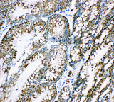 HSPE1 / HSP10 / Chaperonin 10 Antibody - HSPE1 / HSP10 / Chaperonin 10 antibody. IHC(P): Human Intestinal Cancer Tissue.