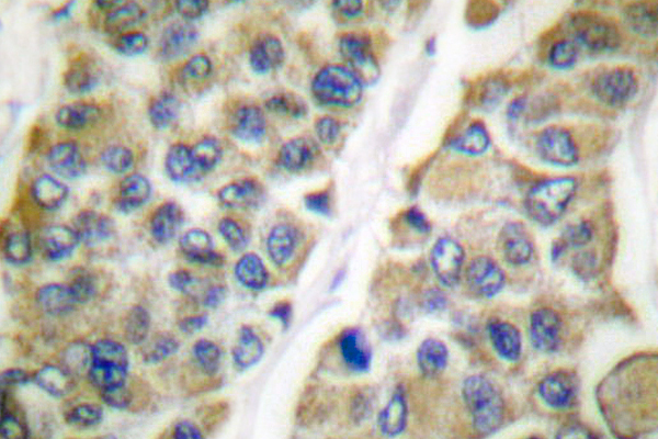 HSPE1 / HSP10 / Chaperonin 10 Antibody - IHC of HSP10 (K80) pAb in paraffin-embedded human breast carcinoma tissue.