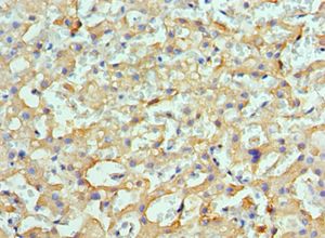 HSPH1 / HSP105 Antibody - Immunohistochemistry of paraffin-embedded human liver cancer using antibody at 1:100 dilution.