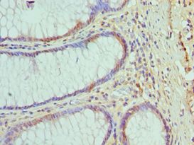 HSPH1 / HSP105 Antibody - Immunohistochemistry of paraffin-embedded human colon cancer using antibody at 1:100 dilution.