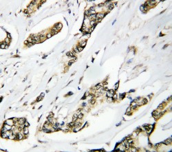 HSPH1 / HSP105 Antibody - WB of HSPH1 / HSP110 antibody. IHC(P): Human Mammary Cancer Tissue.