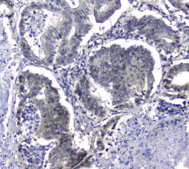 HSPH1 / HSP105 Antibody - IHC analysis of Hsp105 using anti-Hsp105 antibody. Hsp105 was detected in paraffin-embedded section of human intestinal cancer tissues. Heat mediated antigen retrieval was performed in citrate buffer (pH6, epitope retrieval solution) for 20 mins. The tissue section was blocked with 10% goat serum. The tissue section was then incubated with 2µg/ml rabbit anti-Hsp105 Antibody overnight at 4°C. Biotinylated goat anti-rabbit IgG was used as secondary antibody and incubated for 30 minutes at 37°C. The tissue section was developed using Strepavidin-Biotin-Complex (SABC) with DAB as the chromogen.