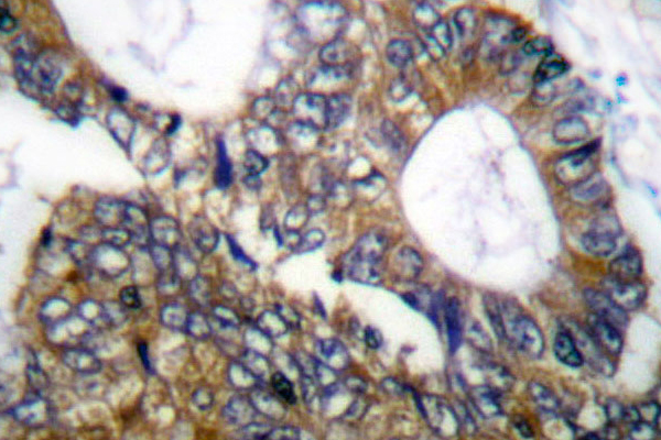 HSPH1 / HSP105 Antibody - IHC of HSP105 (P819) pAb in paraffin-embedded human colon carcinoma tissue.