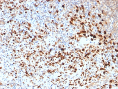 HSV-1 / Herpes Simplex Virus 1 Antibody - Formalin-fixed, paraffin-embedded human Cervix stained with HSV1 Mouse Recombinant Monoclonal Antibody (HSV1/1934).