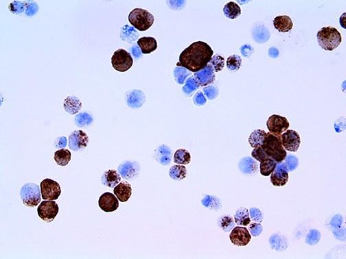 HSV-2 / Herpes Simplex Virus 2 Antibody - IHC of HSV II on a FFPE Infected Cell Line