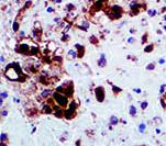HSV-2 / Herpes Simplex Virus 2 Antibody - IHC of HSV II on FFPE Infected tissue. This image was taken for the unmodified form of this product. Other forms have not been tested.