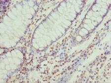 HT2A / TRIM32 Antibody - Immunohistochemistry of paraffin-embedded human colon cancer tissue at dilution 1:100