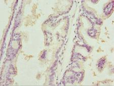 HT2A / TRIM32 Antibody - Immunohistochemistry of paraffin-embedded human prostate cancer tissue at dilution 1:100