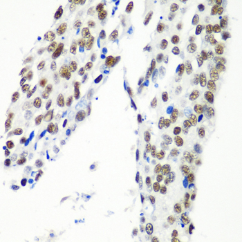 HTATSF1 / TAT-SF1 Antibody - Immunohistochemistry of paraffin-embedded human lung cancer tissue.