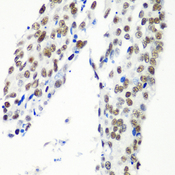 HTATSF1 / TAT-SF1 Antibody - Immunohistochemistry of paraffin-embedded human lung cancer tissue.