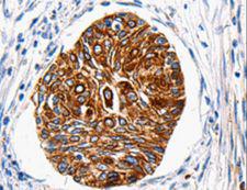 HTR1A / 5-HT1A Receptor Antibody - Immunohistochemistry of paraffin-embedded Human cervical cancer using HTR1A Polyclonal Antibody at dilution of 1:100.