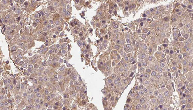HTR1B / 5-HT1B Receptor Antibody - 1:100 staining human liver carcinoma tissues by IHC-P. The sample was formaldehyde fixed and a heat mediated antigen retrieval step in citrate buffer was performed. The sample was then blocked and incubated with the antibody for 1.5 hours at 22°C. An HRP conjugated goat anti-rabbit antibody was used as the secondary.