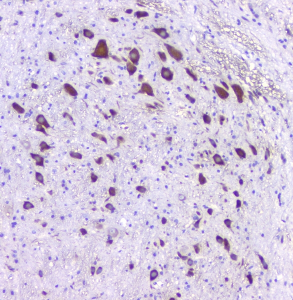 HTR2A / 5-HT2A Receptor Antibody - IHC analysis of 5HT2A Receptor using anti-5HT2A Receptor antibody. 5HT2A Receptor was detected in paraffin-embedded section of rat brain tissues. Heat mediated antigen retrieval was performed in citrate buffer (pH6, epitope retrieval solution) for 20 mins. The tissue section was blocked with 10% goat serum. The tissue section was then incubated with 1µg/ml rabbit anti-5HT2A Receptor Antibody overnight at 4°C. Biotinylated goat anti-rabbit IgG was used as secondary antibody and incubated for 30 minutes at 37°C. The tissue section was developed using Strepavidin-Biotin-Complex (SABC) with DAB as the chromogen.