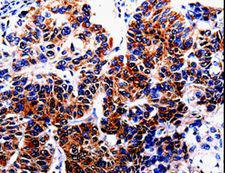 HTR2B / 5-HT2B Receptor Antibody - Immunohistochemistry of paraffin-embedded Human lung cancer using HTR2B Polyclonal Antibody at dilution of 1:20.
