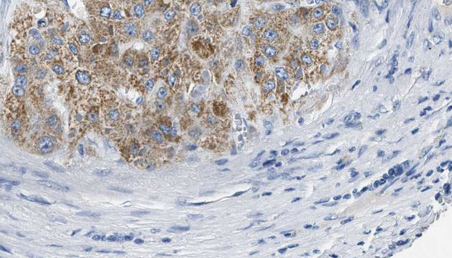 HTR2B / 5-HT2B Receptor Antibody - 1:100 staining human liver carcinoma tissues by IHC-P. The sample was formaldehyde fixed and a heat mediated antigen retrieval step in citrate buffer was performed. The sample was then blocked and incubated with the antibody for 1.5 hours at 22°C. An HRP conjugated goat anti-rabbit antibody was used as the secondary.