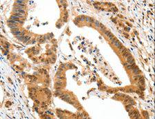 HTR3A / 5-HT3A Receptor Antibody - Immunohistochemistry of paraffin-embedded Human colon cancer using HTR3A Polyclonal Antibody at dilution of 1:50.