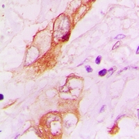 HTR3A / 5-HT3A Receptor Antibody - Immunohistochemical analysis of 5-HT3A staining in human lung cancer formalin fixed paraffin embedded tissue section. The section was pre-treated using heat mediated antigen retrieval with sodium citrate buffer (pH 6.0). The section was then incubated with the antibody at room temperature and detected using an HRP conjugated compact polymer system. DAB was used as the chromogen. The section was then counterstained with haematoxylin and mounted with DPX.