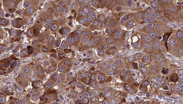 HTR3A / 5-HT3A Receptor Antibody - 1:100 staining human liver carcinoma tissues by IHC-P. The sample was formaldehyde fixed and a heat mediated antigen retrieval step in citrate buffer was performed. The sample was then blocked and incubated with the antibody for 1.5 hours at 22°C. An HRP conjugated goat anti-rabbit antibody was used as the secondary.