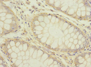 HTR3B / 5-HT3B Receptor Antibody - Immunohistochemistry of paraffin-embedded human colon cancer at dilution 1:100
