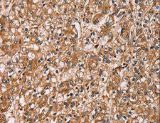 HTR3C / 5-HT3C Receptor Antibody - Immunohistochemistry of paraffin-embedded Human prostate cancer using HTR3C Polyclonal Antibody at dilution of 1:30.