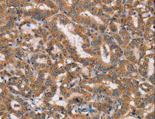 HTR3C / 5-HT3C Receptor Antibody - Immunohistochemistry of paraffin-embedded Human thyroid cancer using HTR3C Polyclonal Antibody at dilution of 1:40.