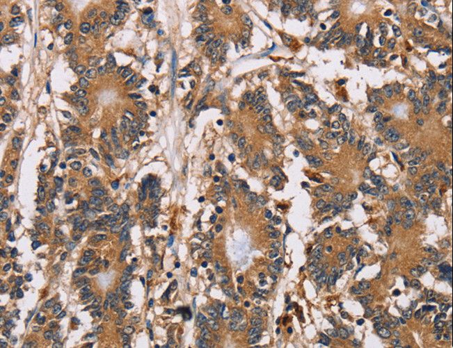 HTR3C / 5-HT3C Receptor Antibody - Immunohistochemistry of paraffin-embedded Human colon cancer using HTR3C Polyclonal Antibody at dilution of 1:40.