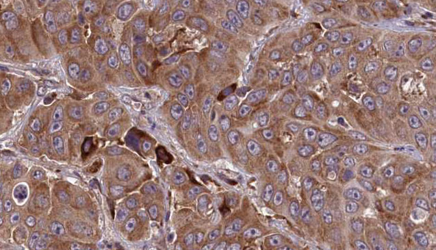 HTR3E / 5-HT3E Receptor Antibody - 1:100 staining human liver carcinoma tissues by IHC-P. The sample was formaldehyde fixed and a heat mediated antigen retrieval step in citrate buffer was performed. The sample was then blocked and incubated with the antibody for 1.5 hours at 22°C. An HRP conjugated goat anti-rabbit antibody was used as the secondary.