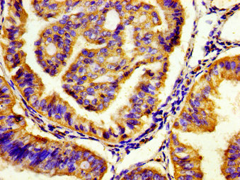 HTR7 / 5HT7 Receptor Antibody - Immunohistochemistry image of paraffin-embedded human endometrial cancer at a dilution of 1:100