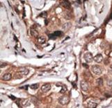 HTRA1 Antibody - Formalin-fixed and paraffin-embedded human cancer tissue reacted with the primary antibody, which was peroxidase-conjugated to the secondary antibody, followed by DAB staining. This data demonstrates the use of this antibody for immunohistochemistry; clinical relevance has not been evaluated. BC = breast carcinoma; HC = hepatocarcinoma.