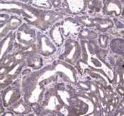 HTRA1 Antibody - IHC testing of FFPE human rectal cancer tissue with HTRA1 antibody at 1ug/ml. Required HIER: steam section in pH6 citrate buffer for 20 min and allow to cool prior to staining.