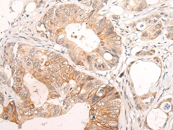 HTRA1 Antibody - Immunohistochemistry of paraffin-embedded Human colorectal cancer tissue  using HTRA1  Polyclonal Antibody at dilution of 1:55(×200)