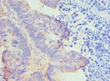 HTRA2 / OMI Antibody - Immunohistochemistry of paraffin-embedded human ovarian cancer using antibody at 1:100 dilution.