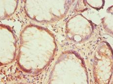 HTRA2 / OMI Antibody - Immunohistochemistry of paraffin-embedded human colorectal carcinoma using antibody at 1:100 dilution.