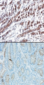 HTRA2 / OMI Antibody - IHC testing using antibody shows cytoplasmic staining in stomach tumor tissue (A) and very weak staining in normal stomach tissue (B).