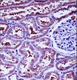 HTRA2 / OMI Antibody - HTRA2 Antibody immunohistochemistry of formalin-fixed and paraffin-embedded human kidney carcinoma followed by peroxidase-conjugated secondary antibody and DAB staining.
