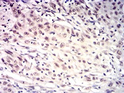 HTRA2 / OMI Antibody - Immunohistochemical analysis of paraffin-embedded esophageal cancer tissues using HTRA2 mouse mAb with DAB staining.