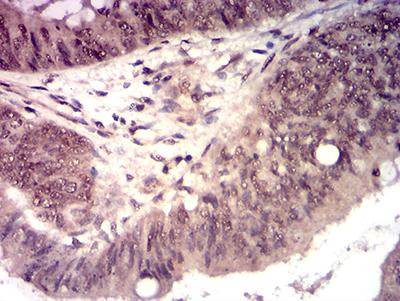 HTRA2 / OMI Antibody - Immunohistochemical analysis of paraffin-embedded esophageal cancer tissues using HTRA2 mouse mAb with DAB staining.