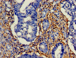HTRA2 / OMI Antibody - Immunohistochemistry of paraffin-embedded human colon cancer using HTRA2 Antibody at dilution of 1:100