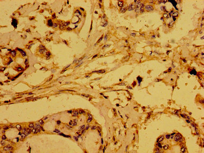 HTRA2 / OMI Antibody - Immunohistochemistry of paraffin-embedded human pancreatic cancer using HTRA2 Antibody at dilution of 1:100
