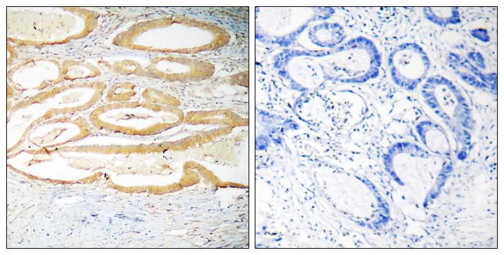 HTRA2 / OMI Antibody - Peptide - + Immunohistochemistry analysis of paraffin-embedded human colon carcinoma tissue using HtrA2(Ab-142) antibody.