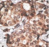 HTRA3 Antibody - Formalin-fixed and paraffin-embedded human cancer tissue reacted with the primary antibody, which was peroxidase-conjugated to the secondary antibody, followed by DAB staining. This data demonstrates the use of this antibody for immunohistochemistry; clinical relevance has not been evaluated. BC = breast carcinoma; HC = hepatocarcinoma.