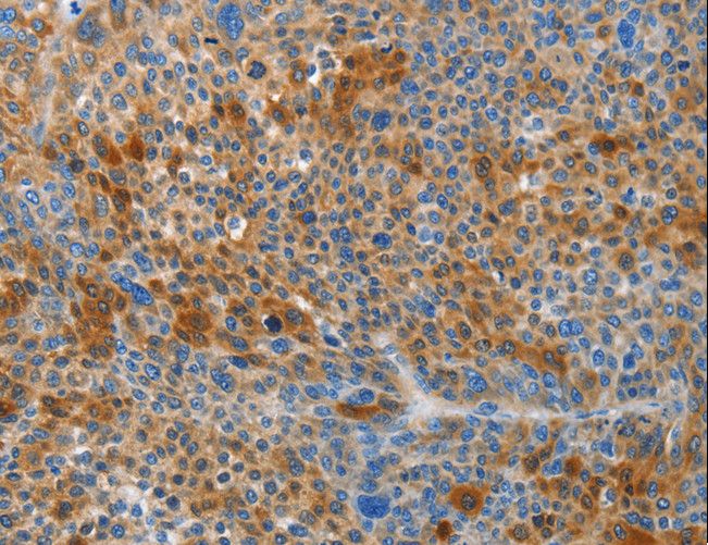 HTRA3 Antibody - Immunohistochemistry of paraffin-embedded Human liver cancer using HTRA3 Polyclonal Antibody at dilution of 1:45.
