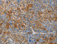 HTRA3 Antibody - Immunohistochemistry of paraffin-embedded Human liver cancer using HTRA3 Polyclonal Antibody at dilution of 1:45.